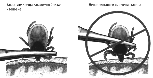 как вытащить клеща пинцетом как вытащить клеща пинцетом